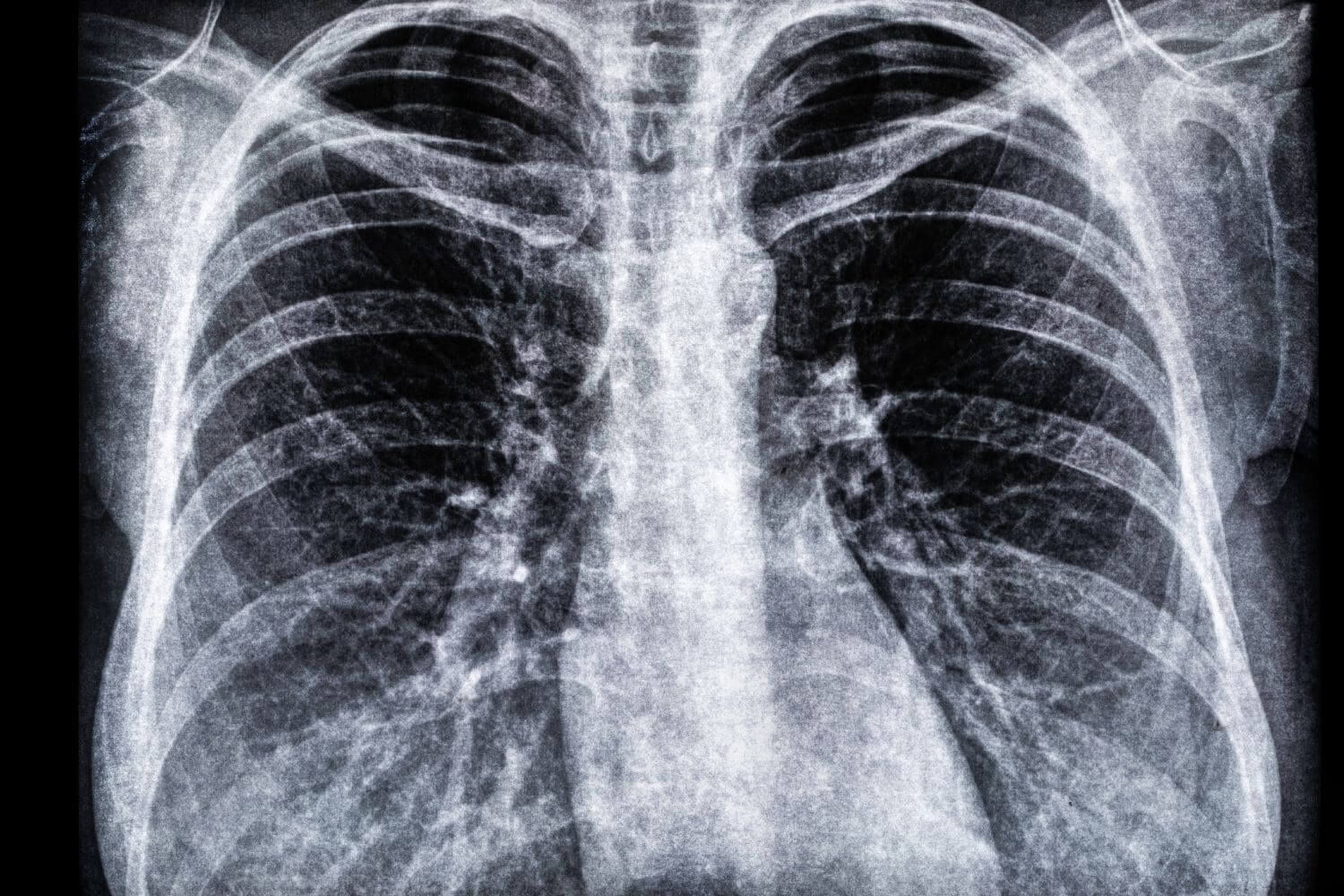 World Cancer Day – Raising Awareness of Asbestos Exposure And Lung Cancer